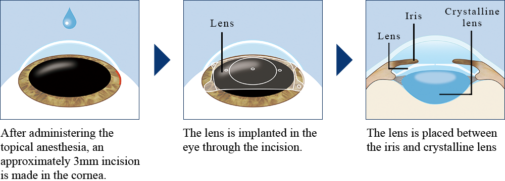 Flow of ICL surgery