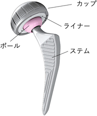 人工股関節インプラント