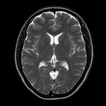 頭部MRI