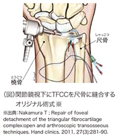 関節視下にTFCCに尺骨に縫合するオリジナル術式