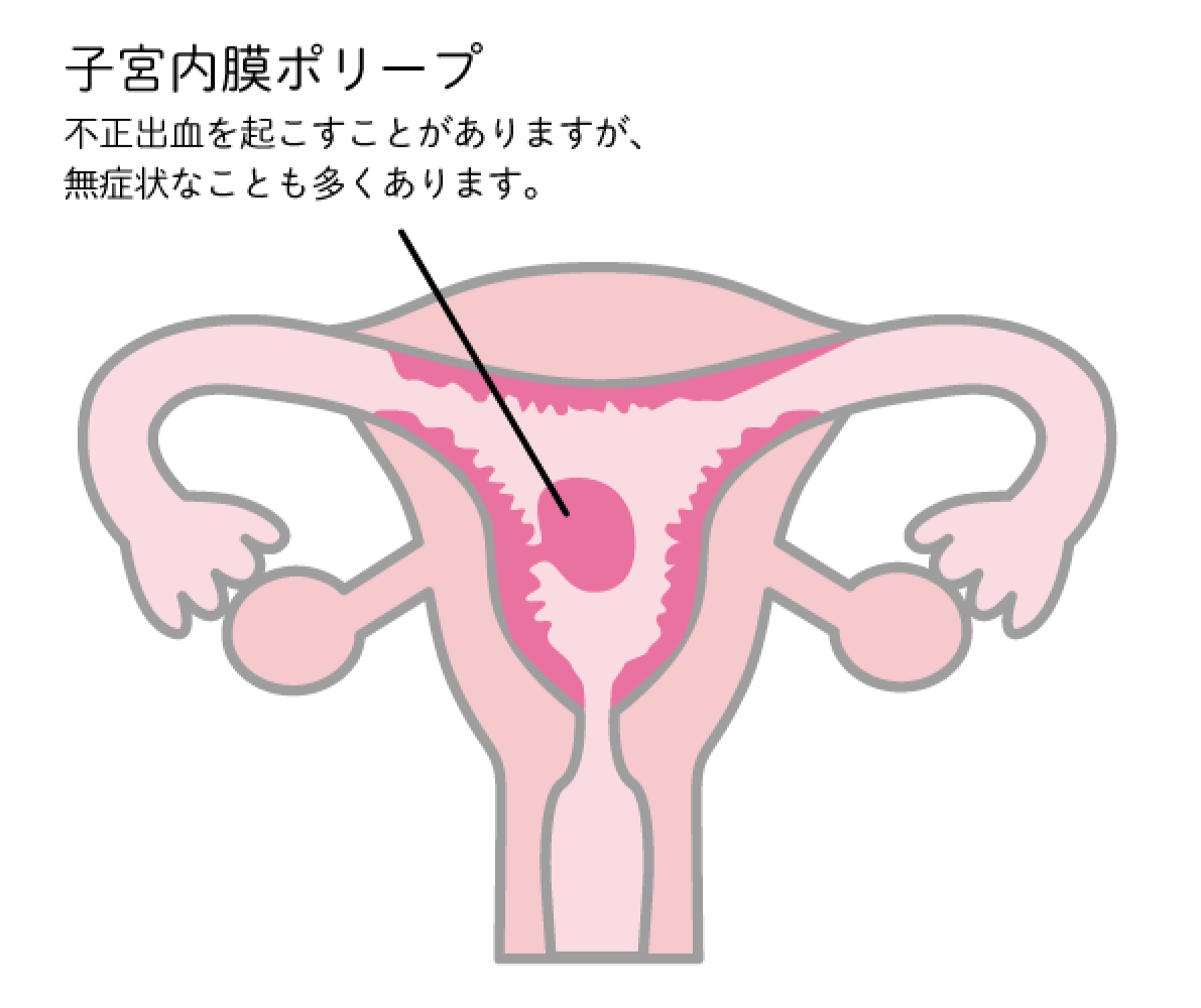 【子宮内膜ポリープ】不正出血を起こすことがありますが、無症状なことも多くあります。