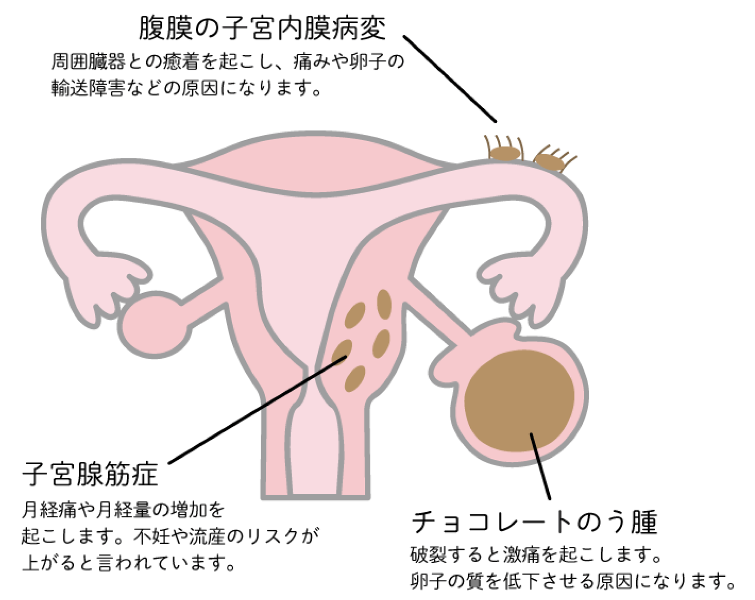 【腹膜の子宮内膜病変】周囲臓器との癒着を起こし、痛みや卵子の輸送障害などの原因になります。【チョコレートのう腫】破裂すると激痛を起こします。卵子の質を低下させる原因になります。【子宫腺筋症】月経痛や月経量の増加を起こします。不妊や流産のリスクが上がると言われています。