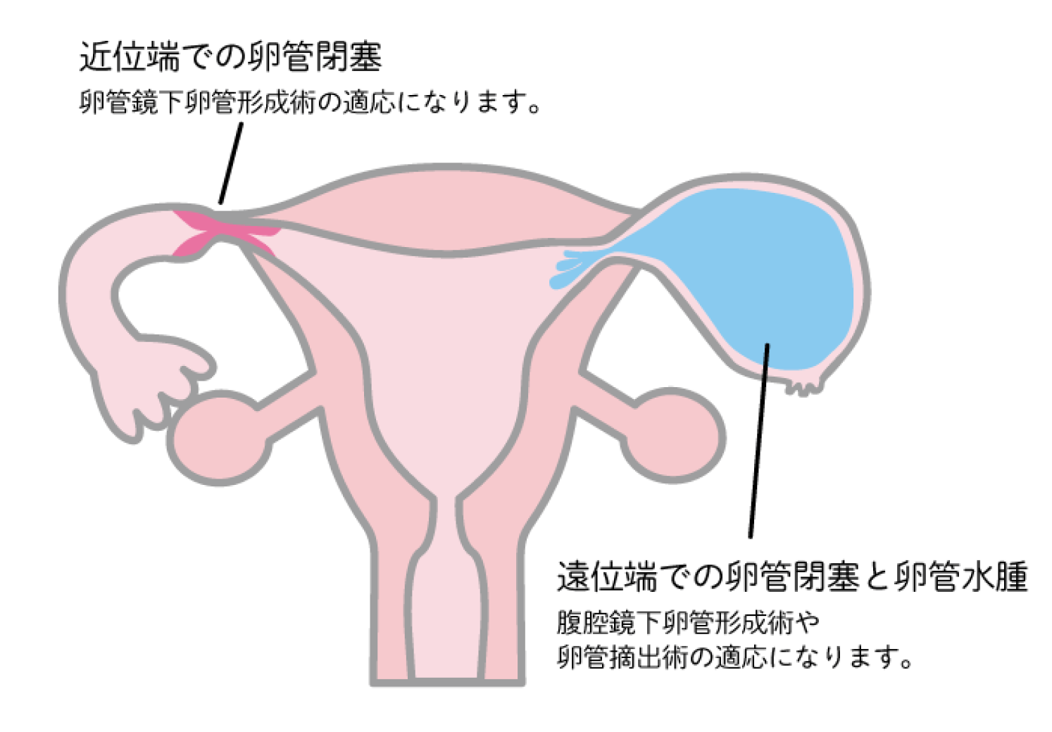 【近位端での卵管閉塞】卵管鏡下卵管形成術の適応になります。【遠位端での卵管閉塞と卵管水腫】腹腔鏡下卵管形成術や卵管摘出術の適応になります。