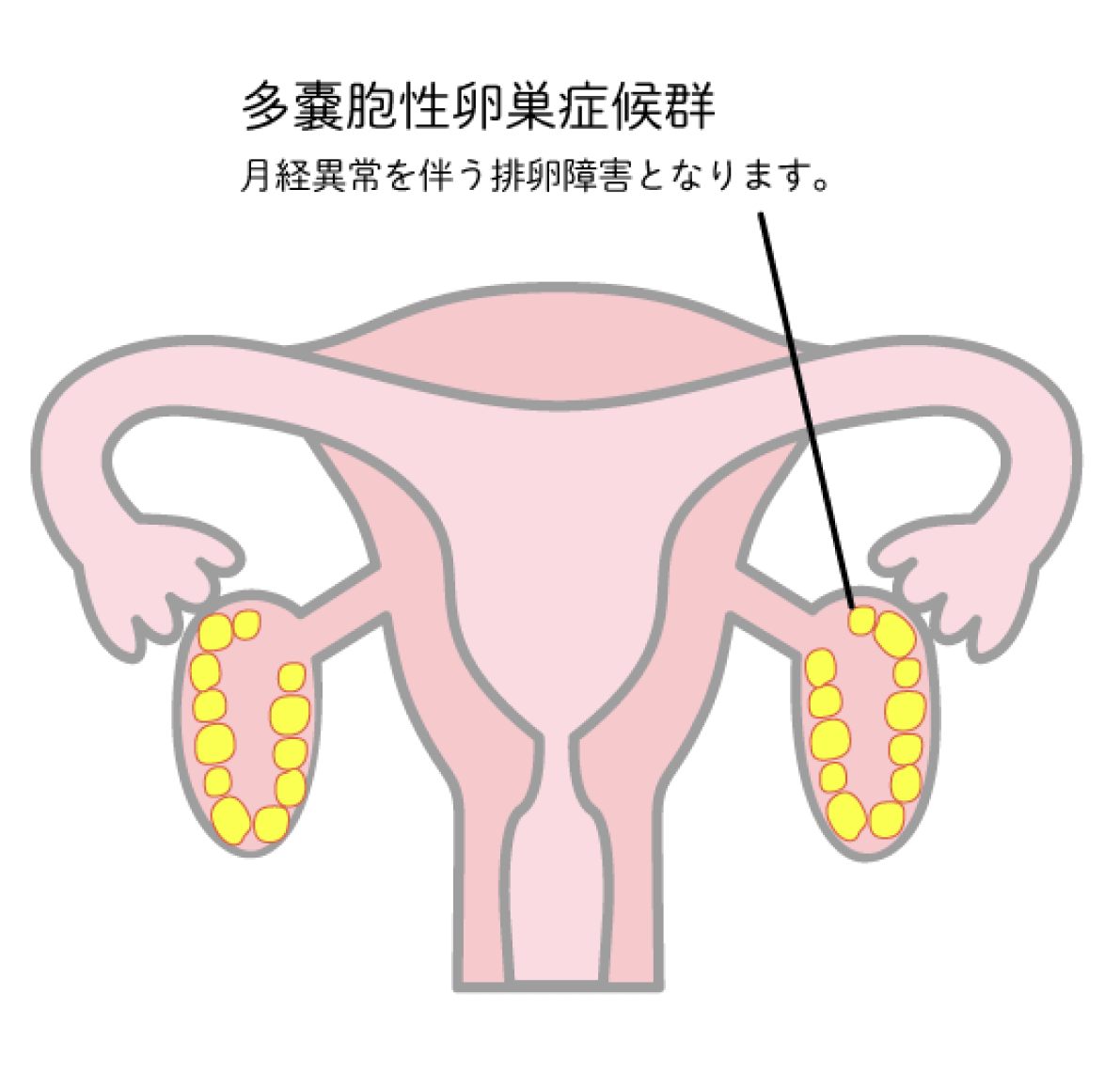 【多のう胞性卵巣症候群】月経異常を伴う排卵障害となります。