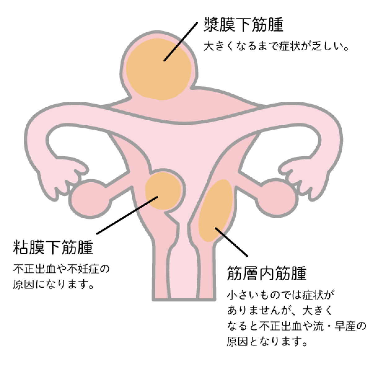 【粘膜下筋腫】不正出血や不妊娠の原因になります。【筋層内筋腫】小さいものでは症状がありませんが、大きくなると不出血や流・早産の原因となります。【漿膜下筋腫】大きくなるまで症状が乏しい。