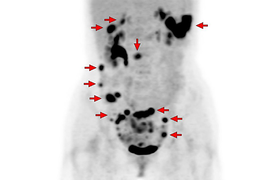 PET-CT(卵巣癌転移)
